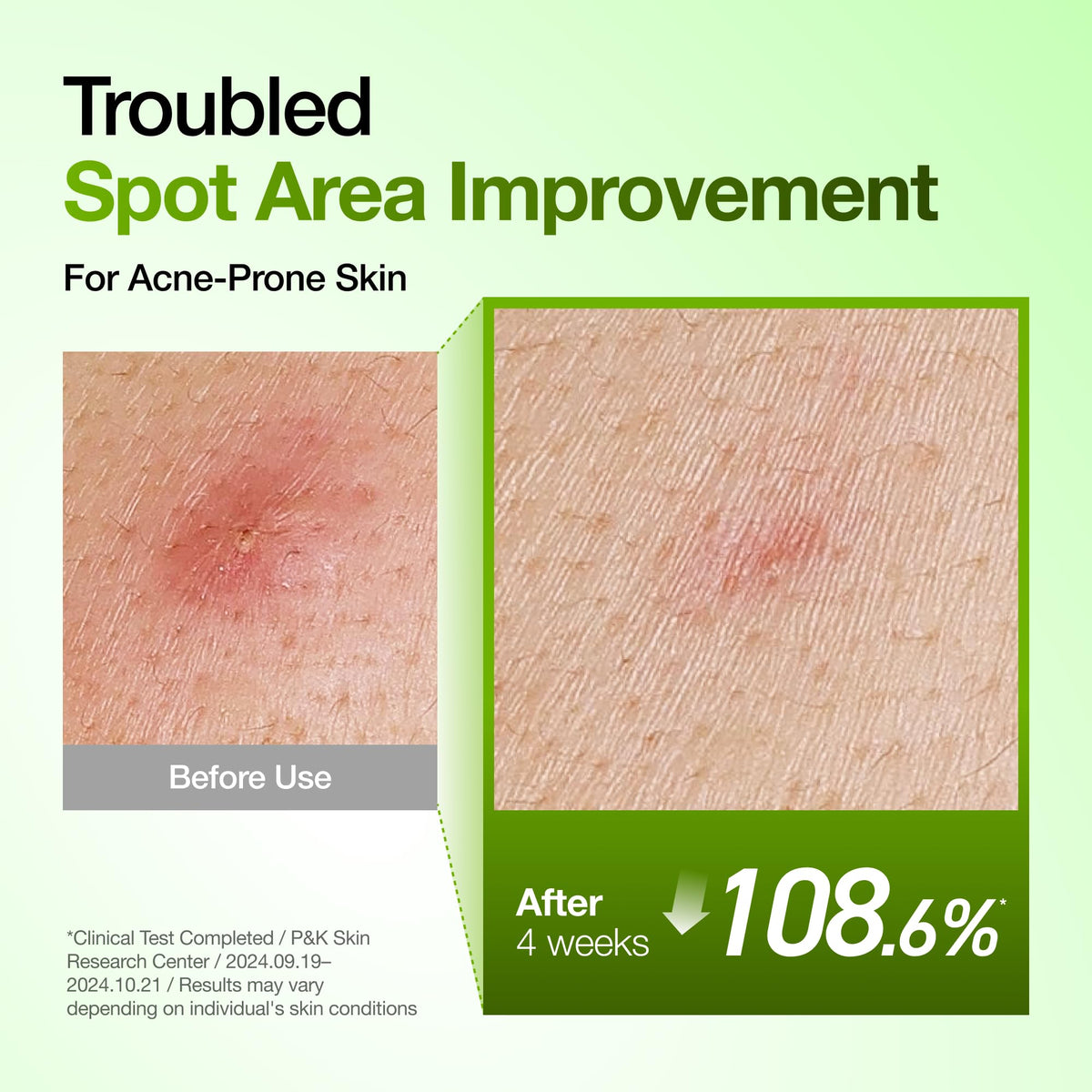 Suero Calmante para Enrojecimiento con Ácido Azelaico 10 de Anua, Suero Facial para Piel Sensible, Ácido Hialurónico, Niacinamida, Cuidado de Manchas, Color Natural, Vegano, Cuidado de la Piel Coreano (30ml/ 1.01 fl oz.)