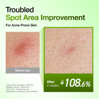 Suero Calmante para Enrojecimiento con Ácido Azelaico 10 de Anua, Suero Facial para Piel Sensible, Ácido Hialurónico, Niacinamida, Cuidado de Manchas, Color Natural, Vegano, Cuidado de la Piel Coreano (30ml/ 1.01 fl oz.)