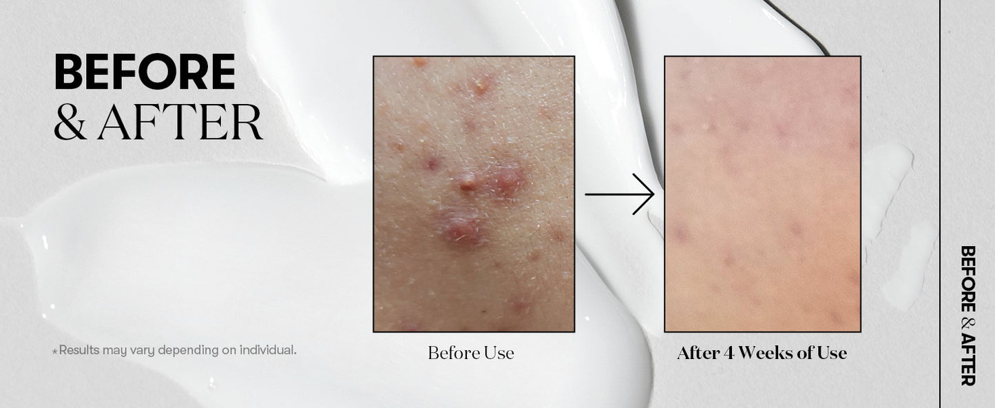 VT COSMETICS CICA Reedle Shot 100, Sérum de Microagulhamento com Espículas para Cuidado dos Poros e Esfoliação, Exossoma, Centella Asiatica para Pele Vidro, Textura da Pele, Potencializador Líquido Coreano para a Pele (1,69 Fl Oz / 50ml)