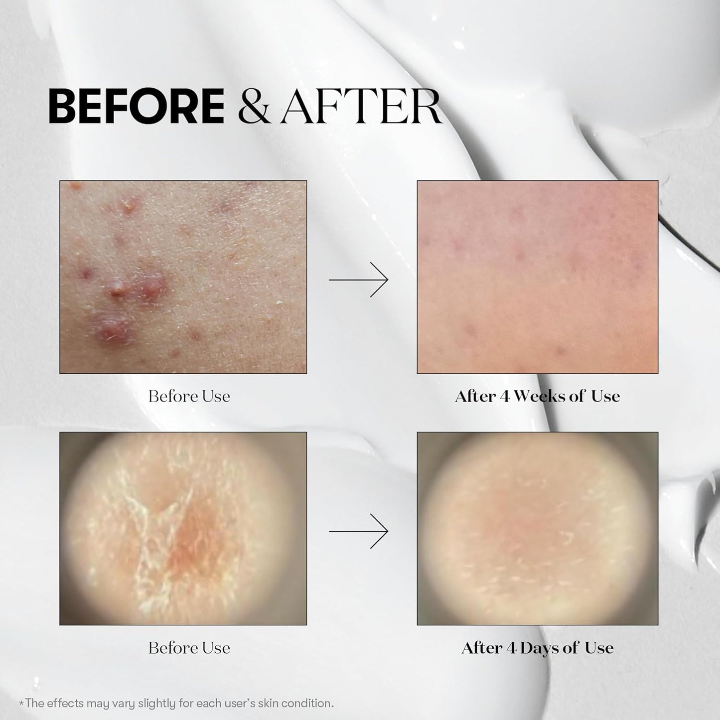 VT COSMETICS CICA Reedle Shot 100, Sérum de Microagulhamento com Espículas para Cuidado dos Poros e Esfoliação, Exossoma, Centella Asiatica para Pele Vidro, Textura da Pele, Potencializador Líquido Coreano para a Pele (1,69 Fl Oz / 50ml)