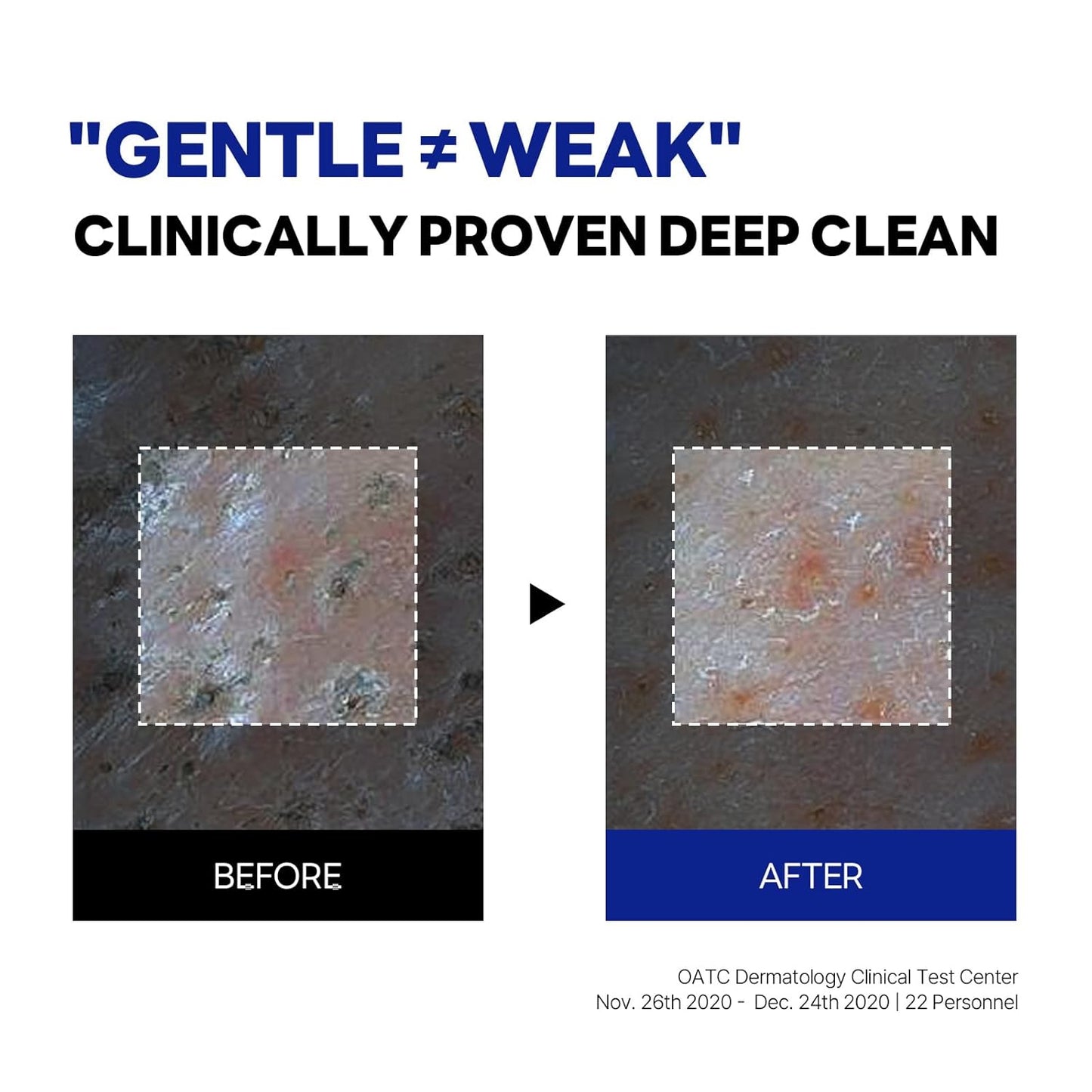 ROUND LAB Gel de Limpeza Hidratante com Suco de Bétula | Desobstrui o sebo oculto, Remove células mortas da pele, Calmante, pH baixo, Gel de Limpeza (150 ml)